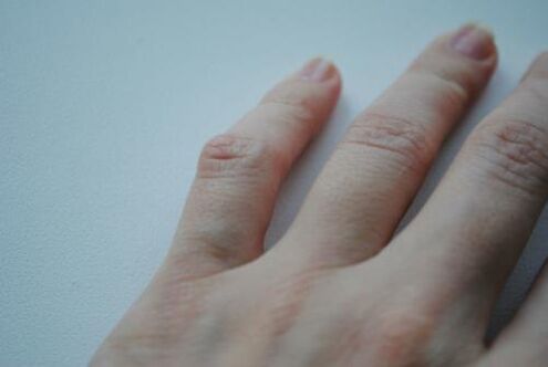 No dedo meñique apareceu unha masa artrítica. 