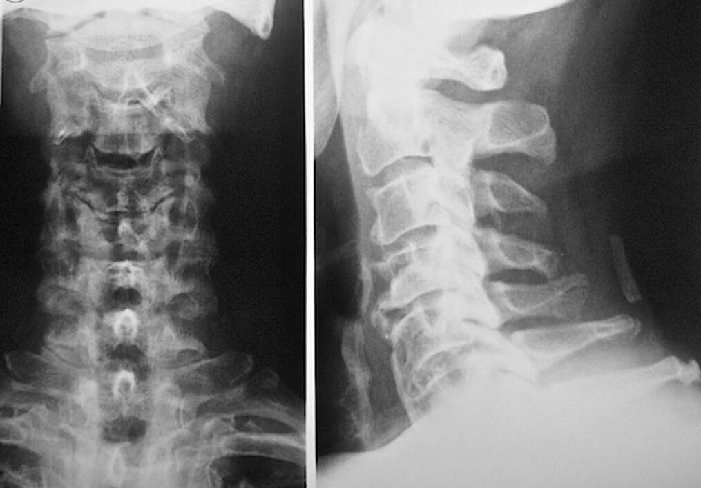 radiografía da columna cervical con osteocondrose