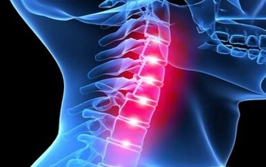 Síntomas da osteocondrose da columna cervical