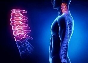 As razóns para o desenvolvemento da osteocondrose cervical