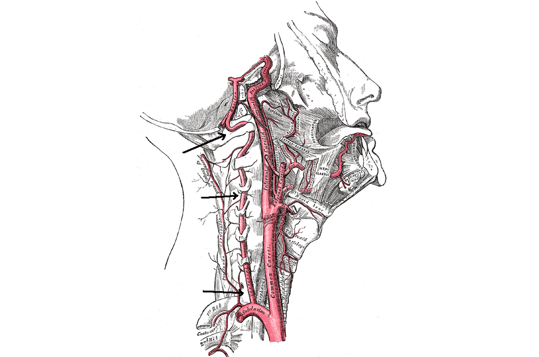 compresión da arteria vertebral con osteocondrose cervical
