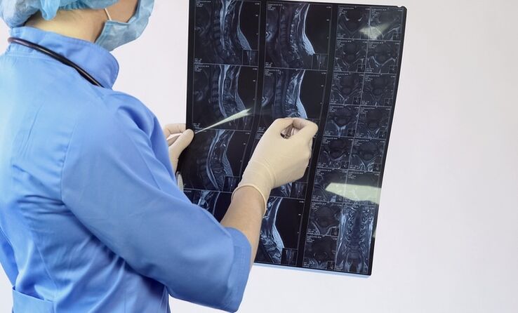 O diagnóstico de osteocondrose cervical realízase a partir dun estudo de resonancia magnética