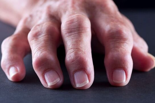 Deformidades articulares dos dedos por artrose ou artrite